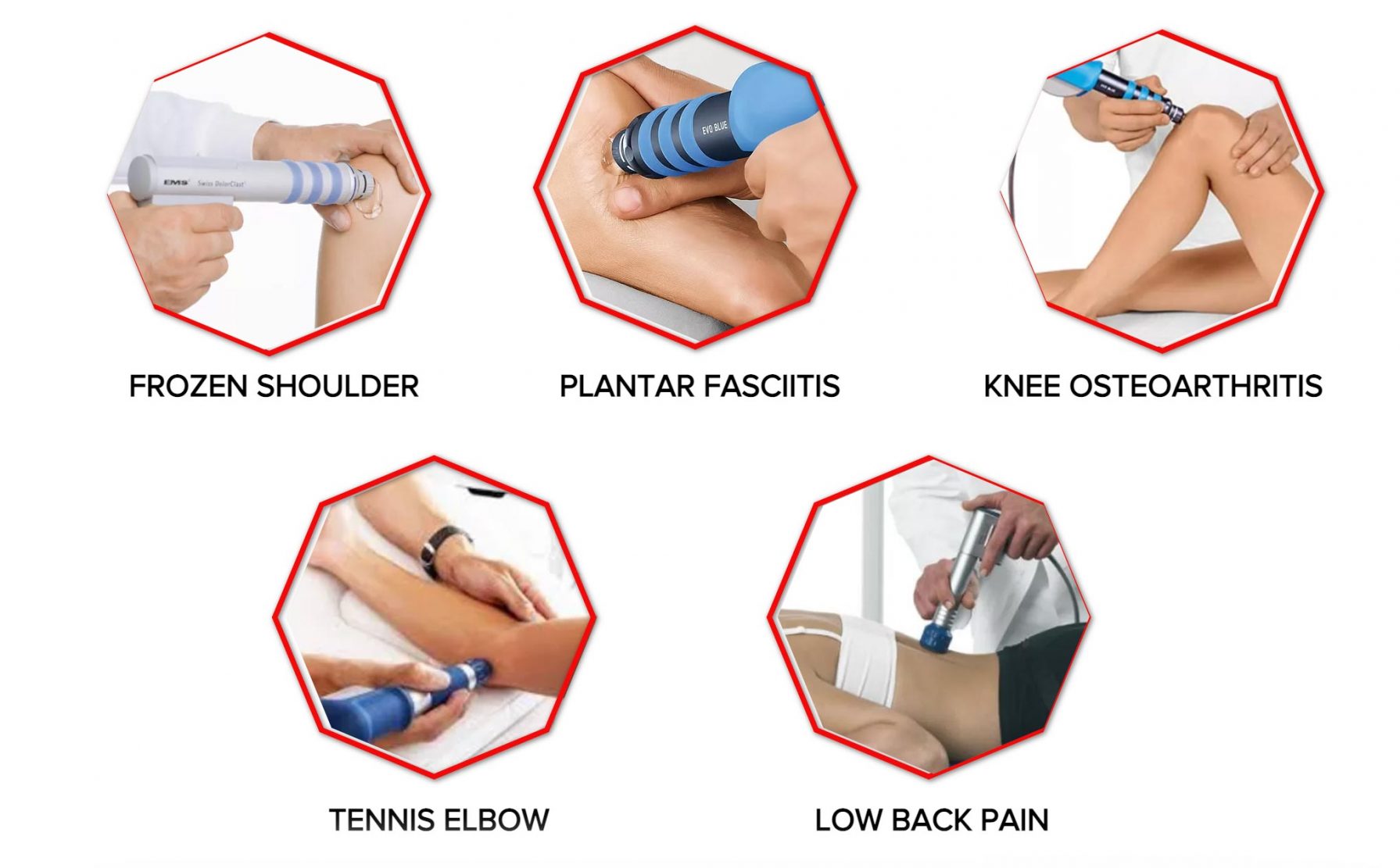 Shockwave Therapy In PJ KL OneSpine Chiropractic Physiotherapy